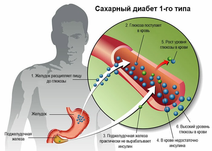 Разница между Диабетом 1 и 2 типа 2 Диабет 1 типа
