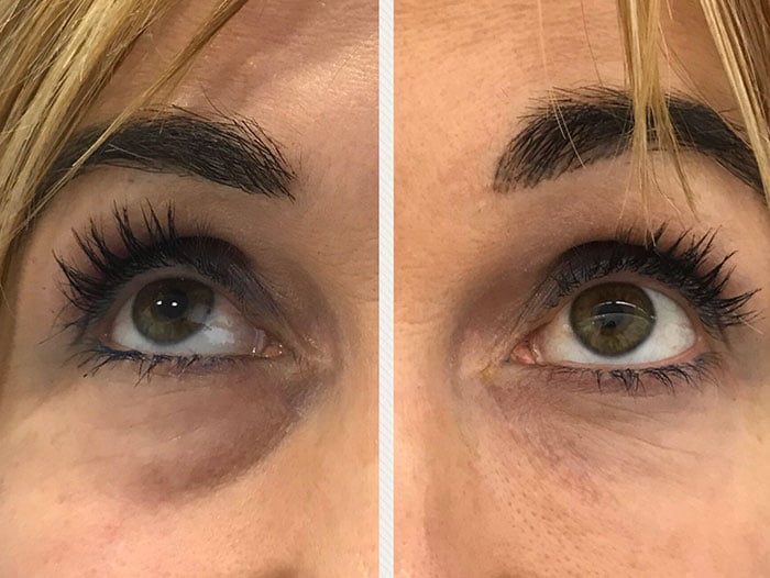tratamiento de ojeras en valencia