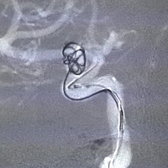 Coiling-Aneurysm-video-bg Coiling-Aneurysm-video-bg