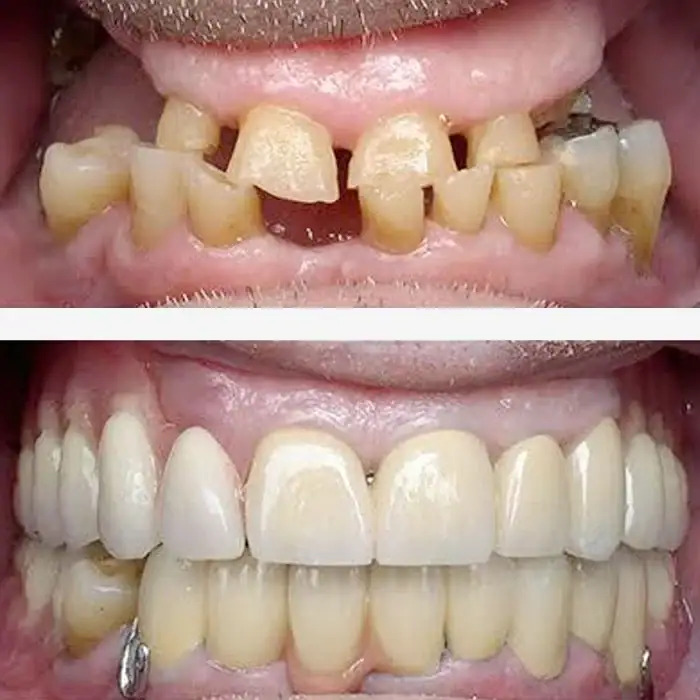 Teeth Restoration Treatment in Coimbatore