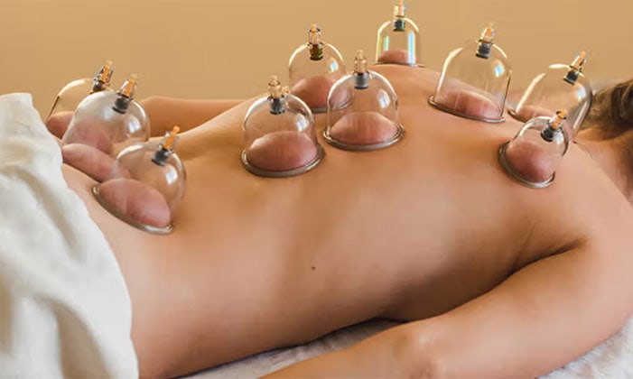 Hijama -A wide-angle view of a patient lying face down during an extensive cupping therapy session. Multiple clear plastic vacuum cups are applied across the patient's entire back, from the lower lumbar region up to the shoulders. The skin is visibly suctioned into each cup, highlighting the myofascial decompression technique used to promote circulation and relieve deep muscle tension in a spa or clinical setting.