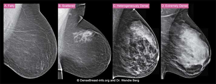 breast-density-2020