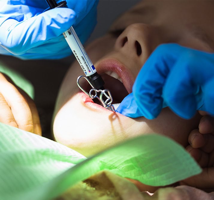 Fracture Broken Tooth