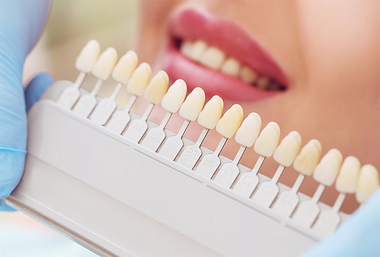 Services---Dental-veneers