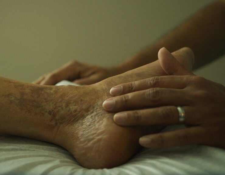 A person gently massages another person's foot, which shows signs of dry, rough, and discolored skin.