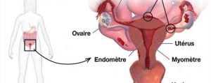 Endométriose