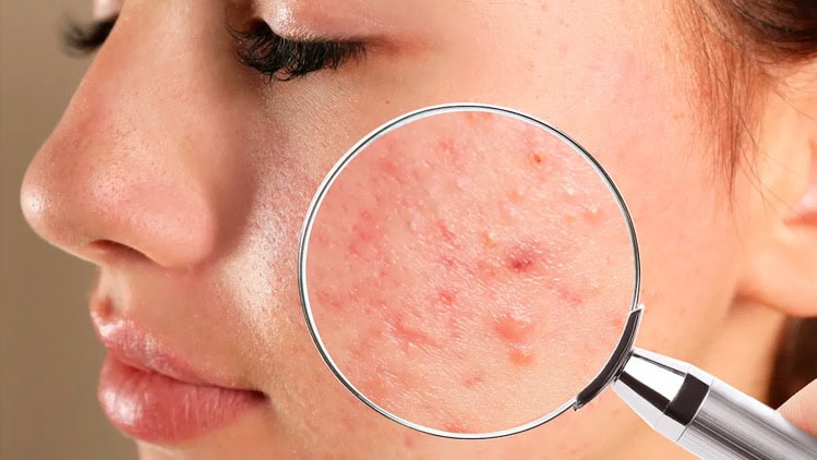 acne