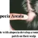 Alopecia Areata - Bald Patch