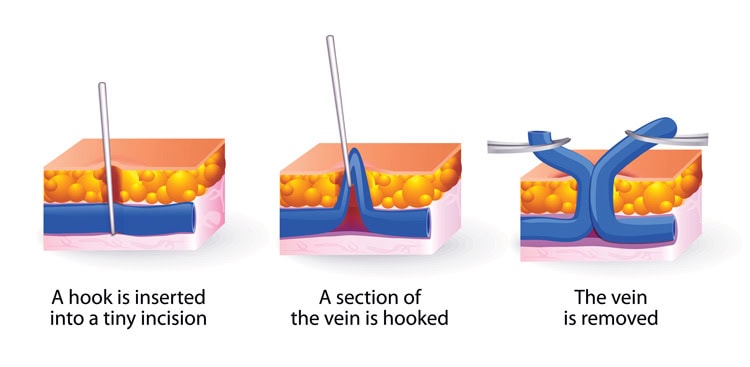 Varicose Vein Removal New Haven CT Varicose Vein Removal New Haven CT