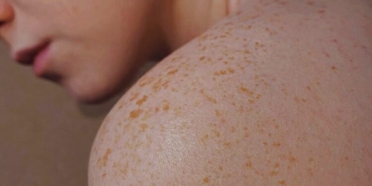 Des kinés formés pour détecter les cancers de la peau