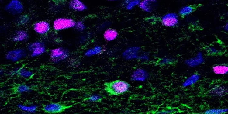 Newborn neuron (green and purple) in brain tissue from human epilepsy patients. (Aswathy Ammothumkandy/Bonaguidi Lab/USC Stem Cell)