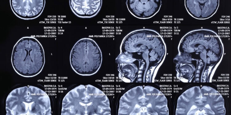 Brain MRI scans showing different views and slices for neurological and psychological research, highlighting brain structure and function analysis.
