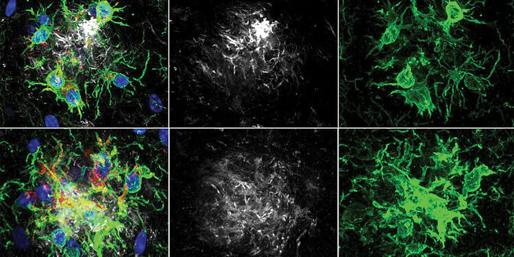 A common enzyme linked to diabetes may offer a new path for treating Alzheimer’s