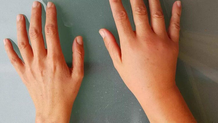 Lymphedema
