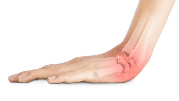 Sprains and Strains