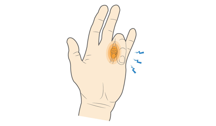 Trigger Finger (Stenosing Tenosynovitis)
