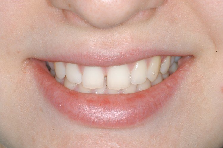 Smile makeover gallery at Frangella Dental Manhattan