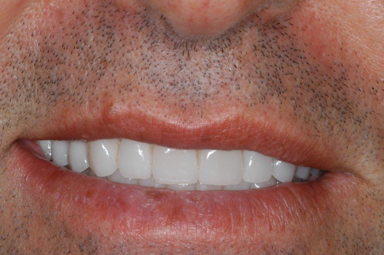 Dental transformation gallery photo at Frangella Dental