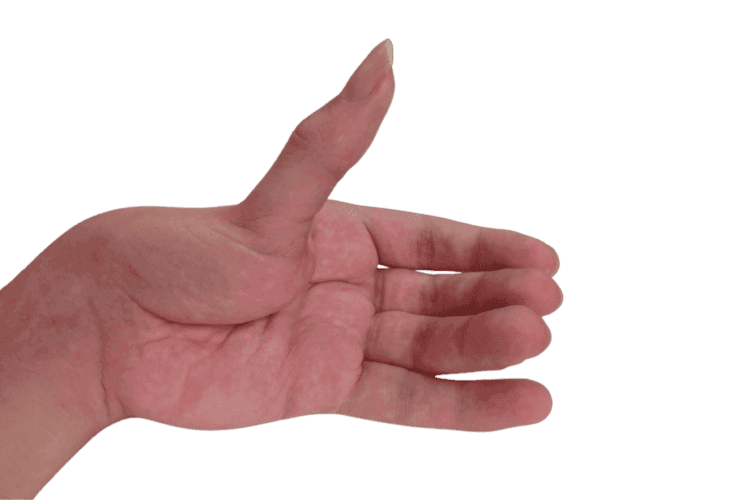 Cerebral palsy & Spastic hand