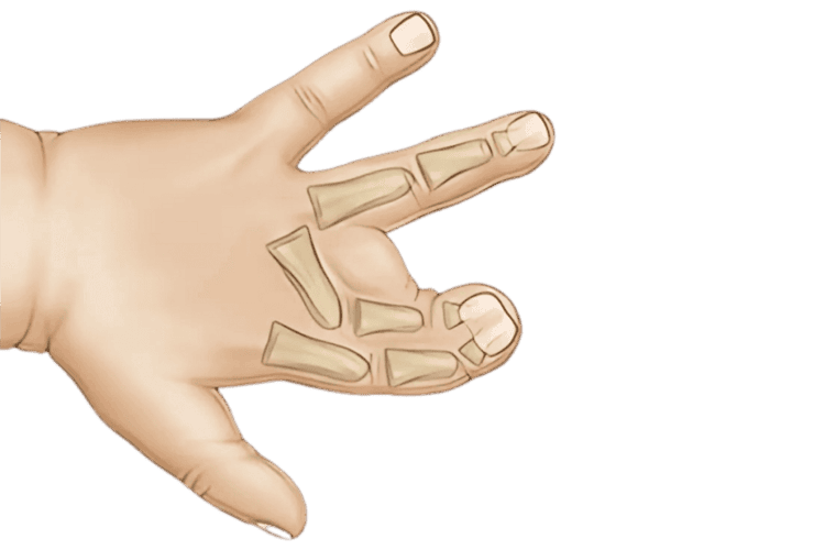 Congenital Hand Differences જન્મજાત હાથના તફાવત
