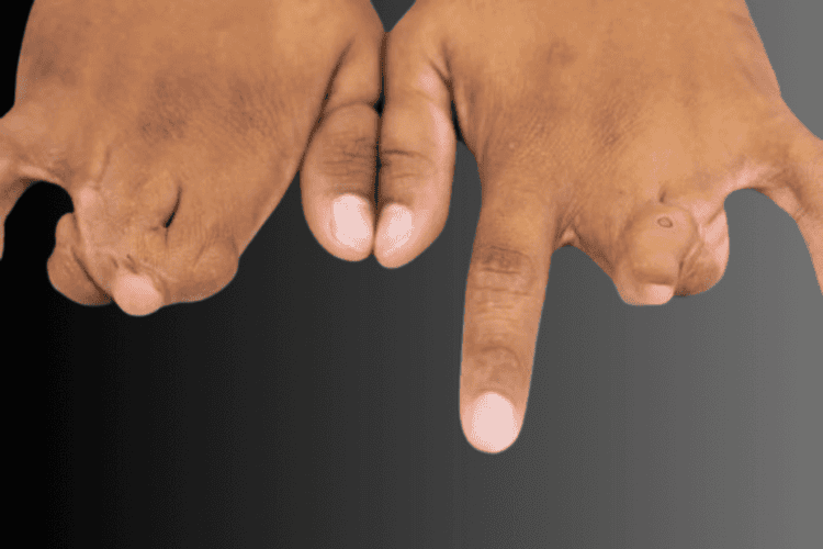 Congenital hand differences