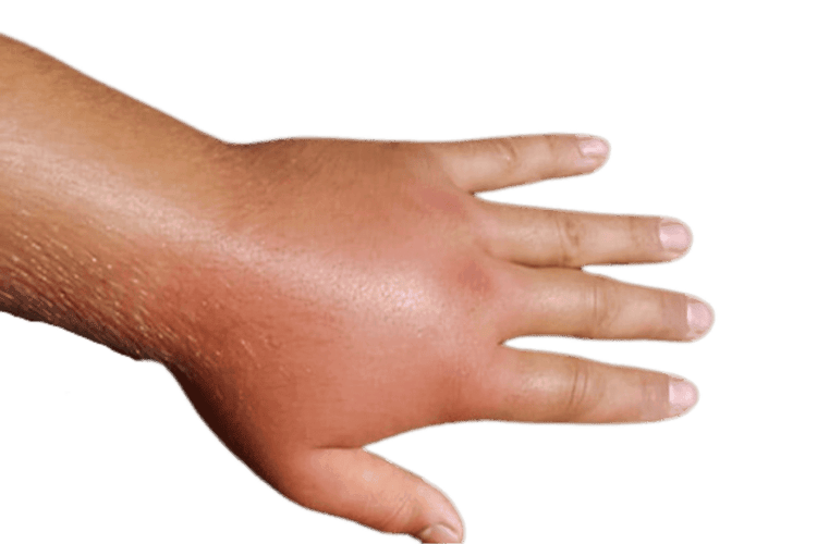 Hand Swelling