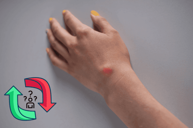 What to do if a ganglion cyst comes back after surgery