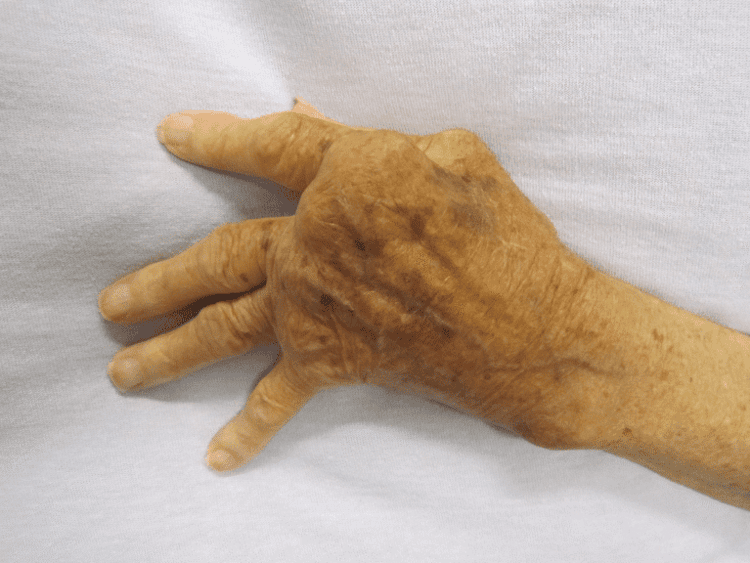 2. Arthritis (Osteoarthritis or Rheumatoid Arthritis)