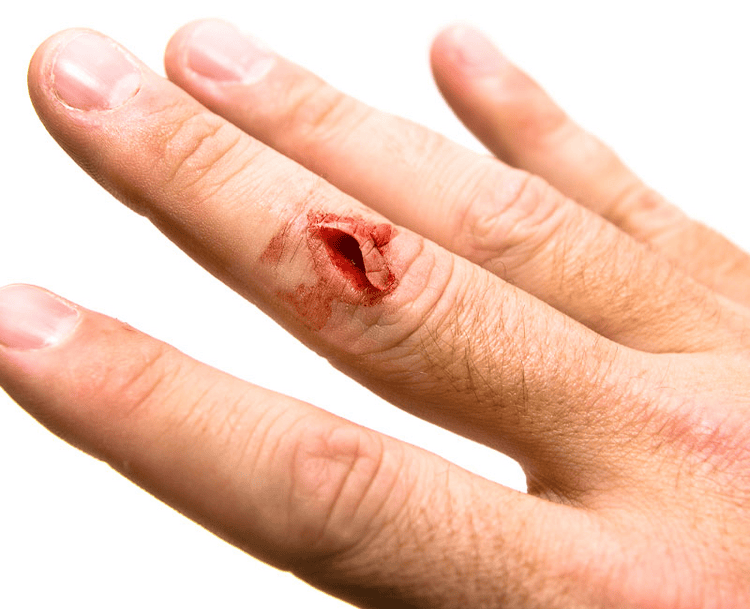 Cuts, Lacerations, and Puncture Wounds Cut Injury on Hand