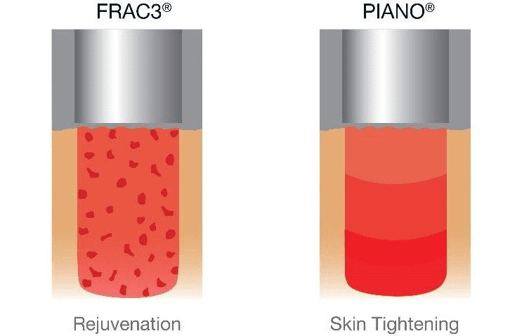 Fotona SmoothEye FRAC3 and PIANO