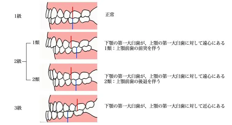 矯正を始めて苦戦したこと🤔💭