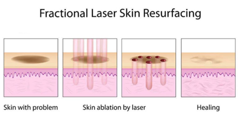 fractional laser skin resurfacing