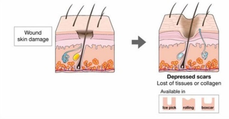 wound skin skin damage and depressed acne scars