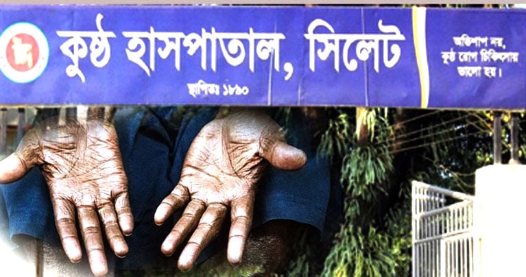 সিলেটে বেড়েছে কুষ্ঠ রোগের সংখ্যা, আক্রান্ত ৪২৬ জন