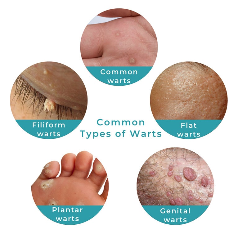 Common Types of Warts