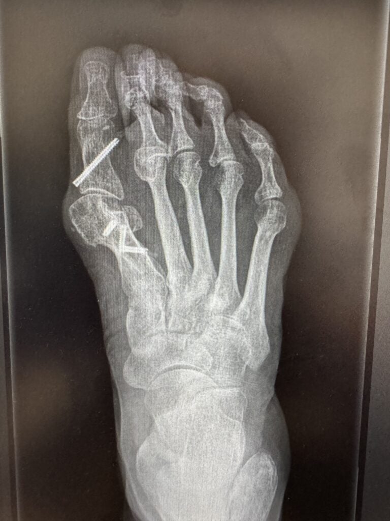 przykład nawrotu koślawości palucha odrastanie haluksa