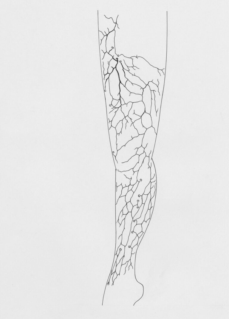 Case Study: Long-Standing Lymphoedema Shows Significant Improvement with Adjunct Red Light and Frequency Therapy
