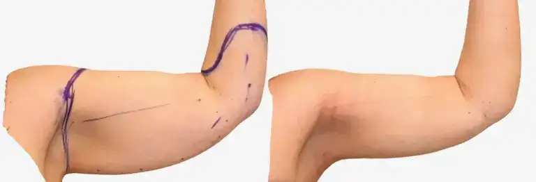 Upper arm marked before arm liposuction