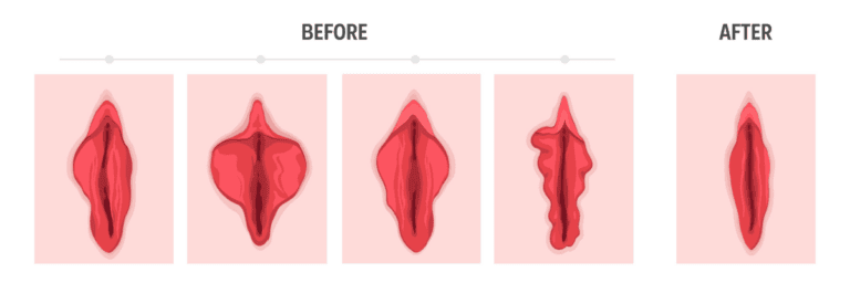 Labiaplasty diagram