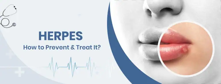 Herpes How to Prevent Treat It
