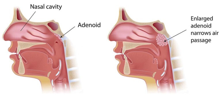 adenoidectomy illustration c9ca65 1