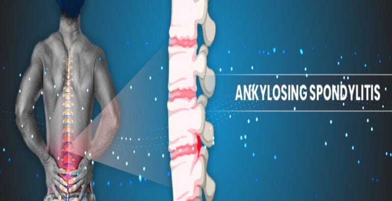 Spondylitis-blog