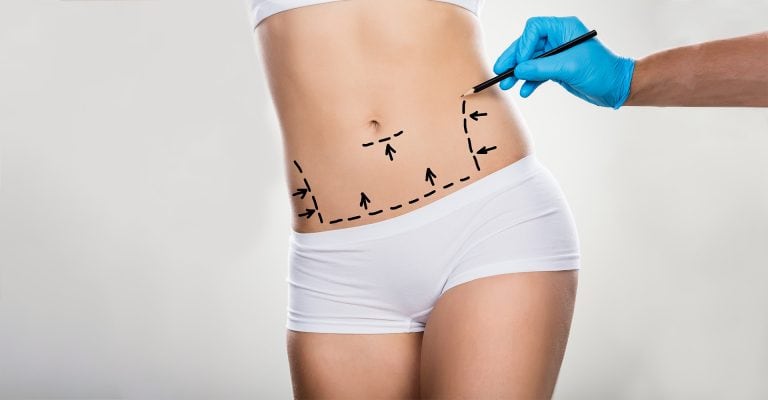 Surgeon marking abdomen with dotted lines and arrows for tummy tuck or liposuction procedure planning