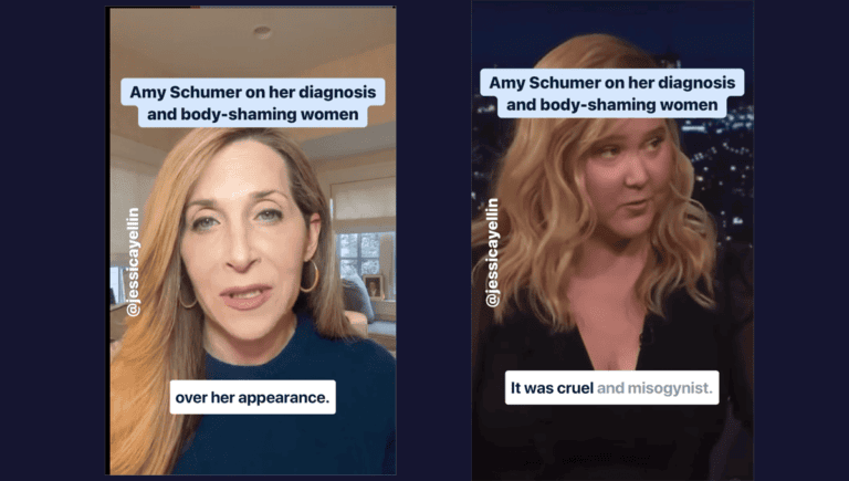 Amy Schumer diagnosed with Cushing Syndrome