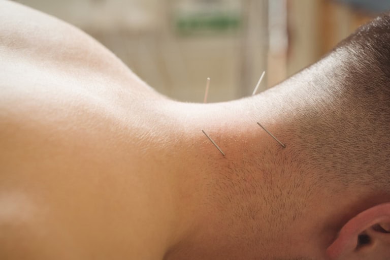 patient getting dry needling neck