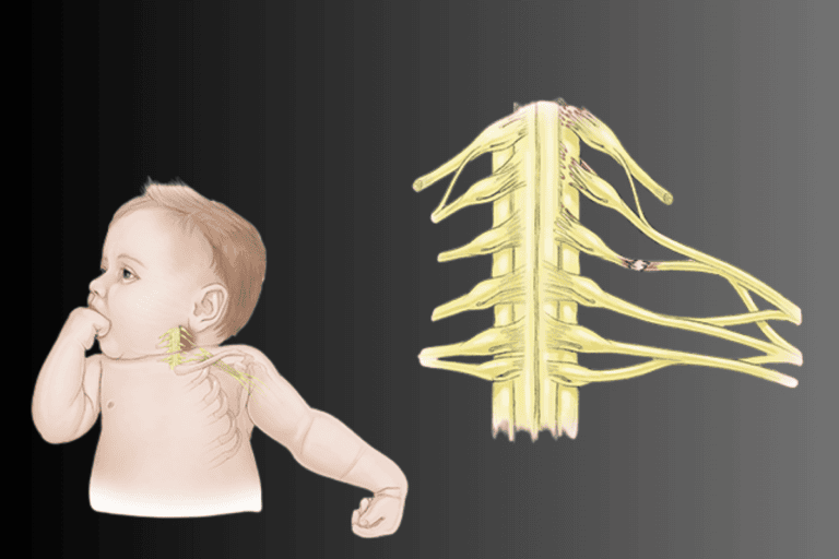 Early warning signs of brachial plexus palsy in newborns & How to act