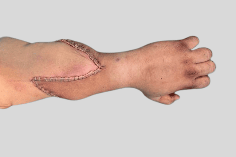 Hand transplant surgery: How It works and Who it’s for?