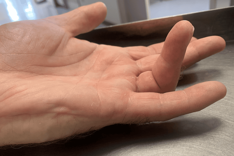 Stiff fingers after surgery: What to expect during rehabilitation?