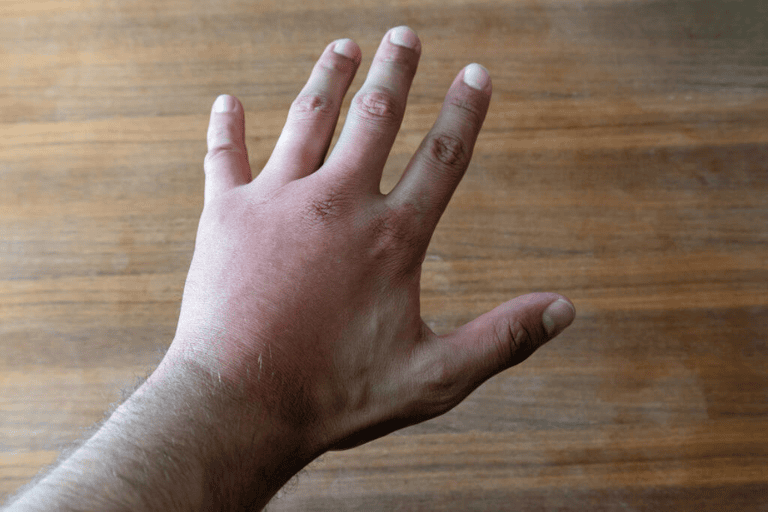 Soft tissue injuries of the hand: When to worry and Seek treatment