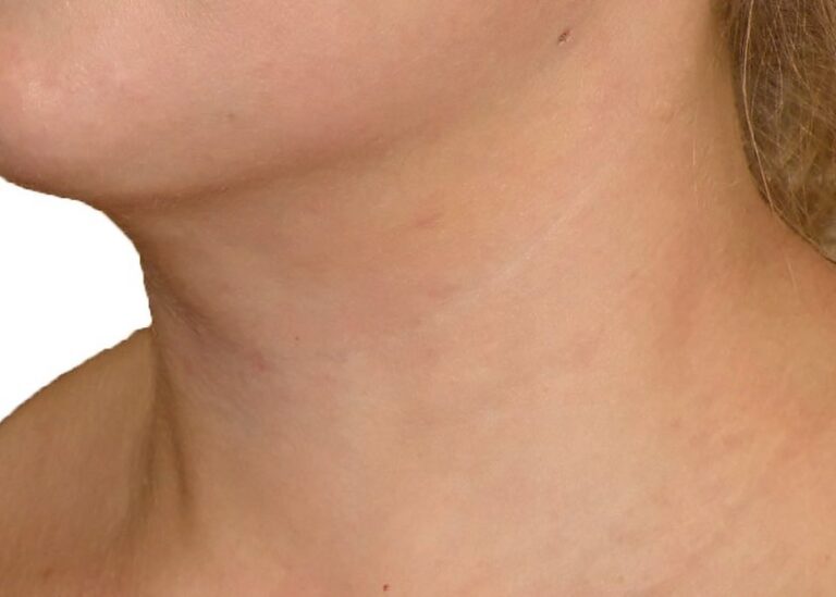 Side view of the chin and neck, chin and neck liposuction